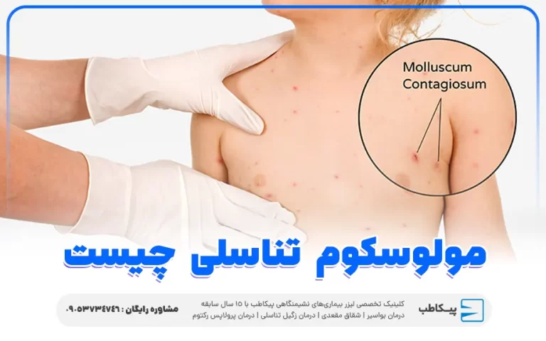 مولوسکوم تناسلی چیست؟