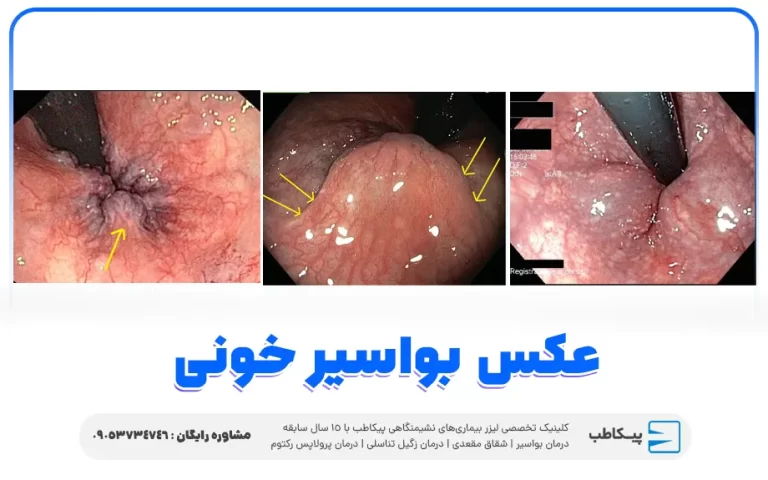 بواسیر خونی