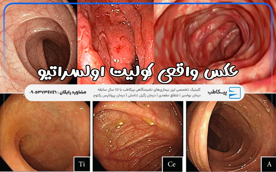 عکس واقعی کولیت اولسراتیو ( کولیت روده )