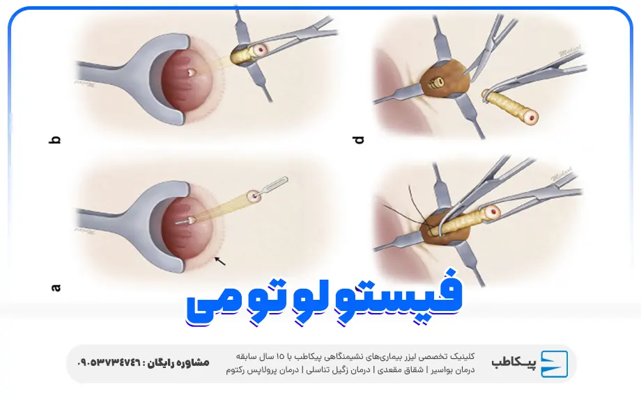 فیستولوتومی