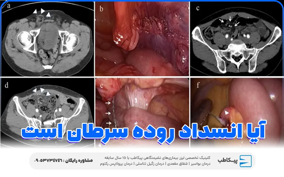 آیا انسداد روده سرطان است؟