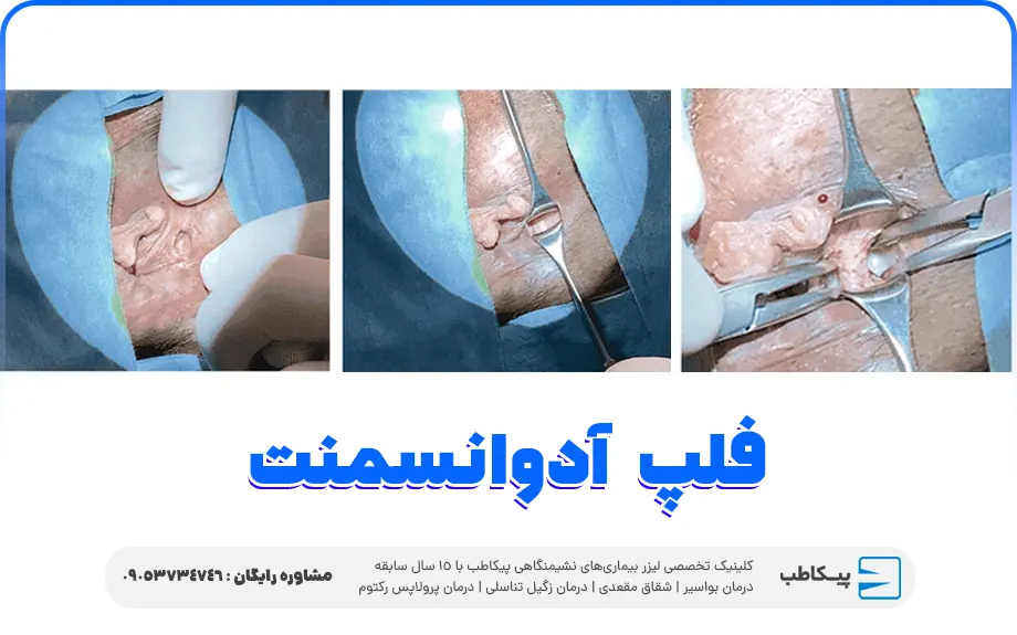 فلپ آدوانسمنت - Mucosal Advancement Flap