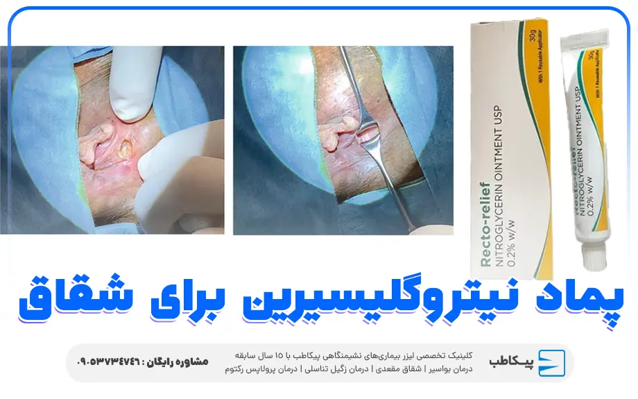 بررسی جامع پماد نیتروگلیسیرین | موارد مصرف و عوارض 6 پماد نیتروگلیسیرین برای شقاق
