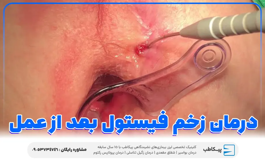 درمان زخم فیستول بعد از عمل