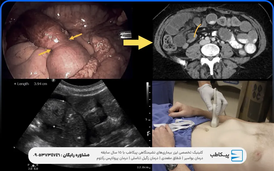 پیشگیری از انسداد روده