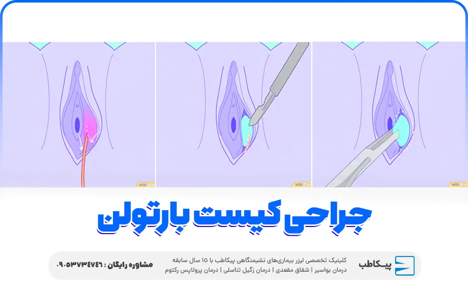 جراحی کیست بارتولن