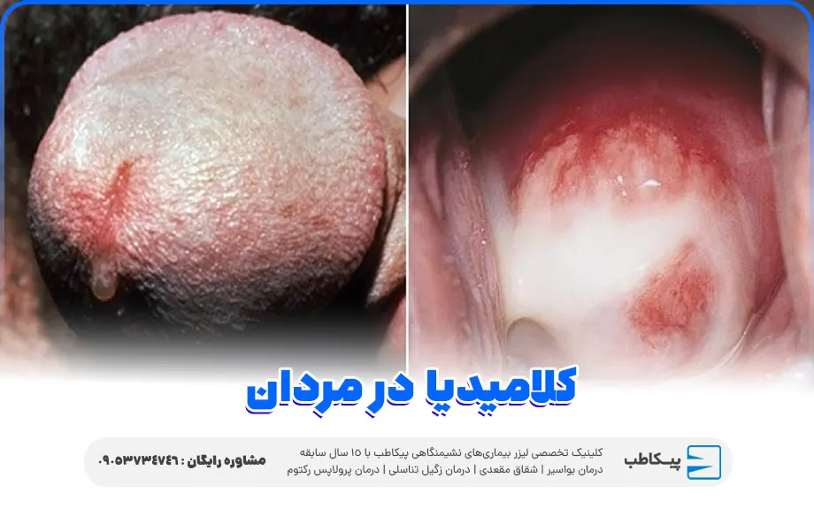 کلامیدیا در مردان
