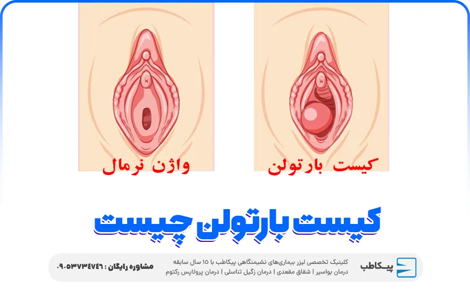 کیست بارتولن چیست | 8 روش درمانی + عوارض و علائم | فیلم عمل