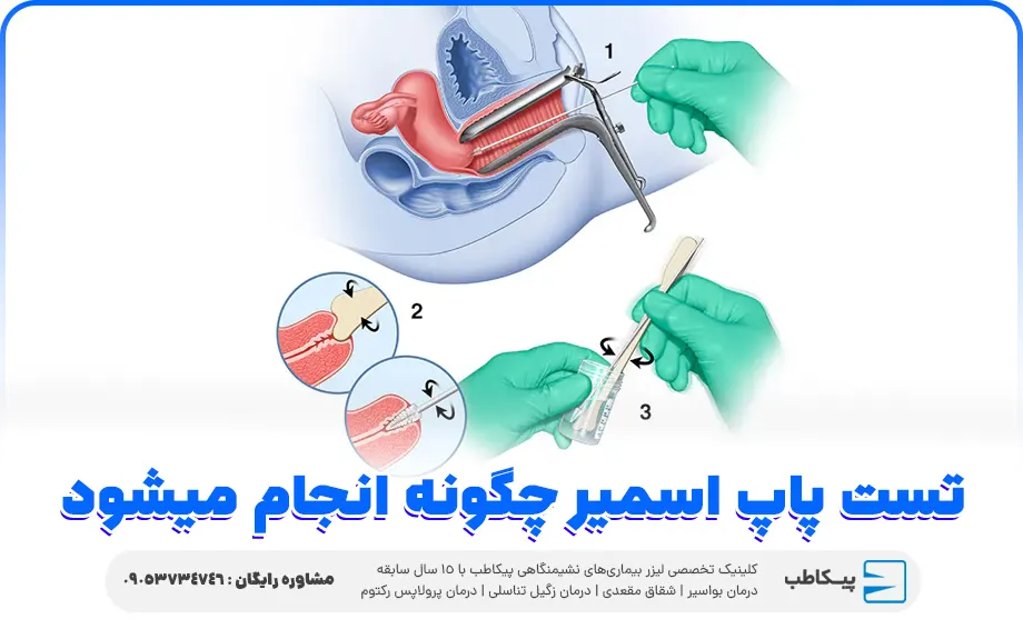 تست پاپ اسمیر چگونه انجام میشود؟