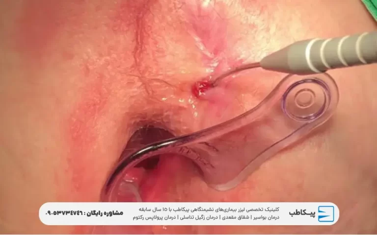 لیزر فیستول مقعدی