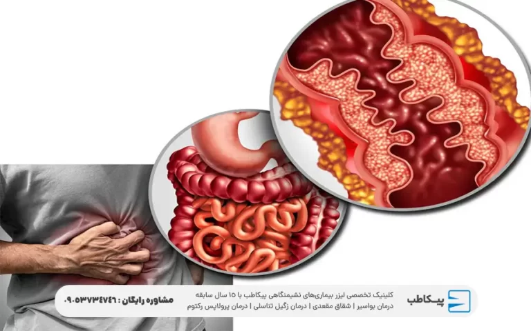 بیماری التهاب روده چیست؟