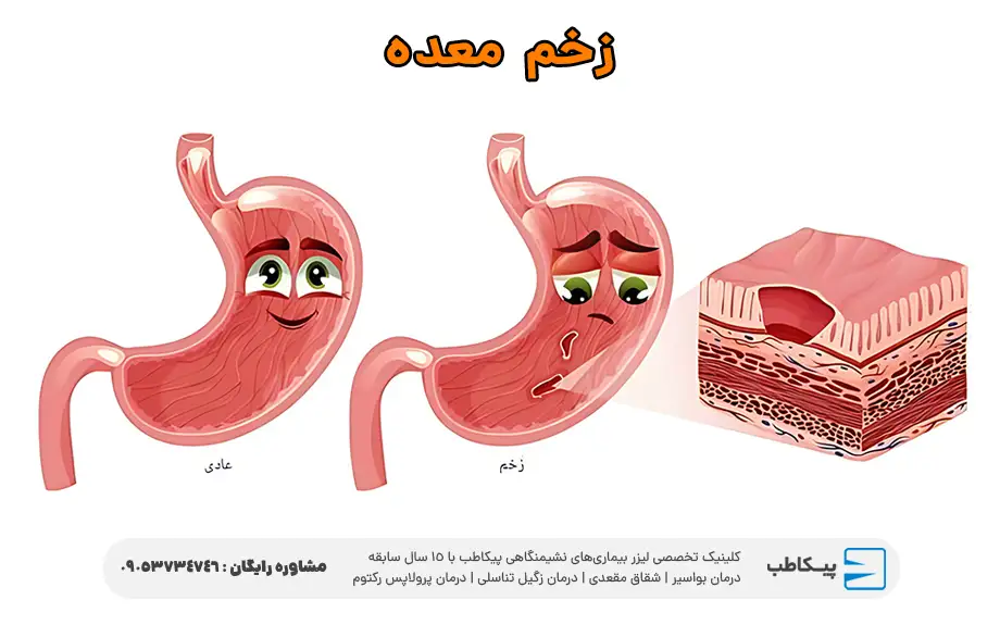 زخم معده