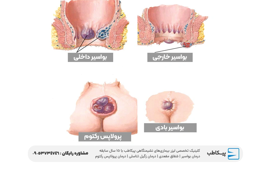 بواسیر بادی